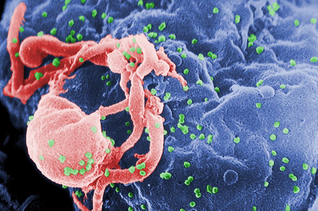 Virusul HIV fixat pe o limfocită văzut în microscopie electronică (culori false, virusul este în verde). Sursă Content Providers: CDC/ C. Goldsmith, P. Feorino, E. L. Palmer, W. R. McManus, Wikipedia.